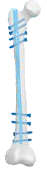 Femur Nailing System In West Siang